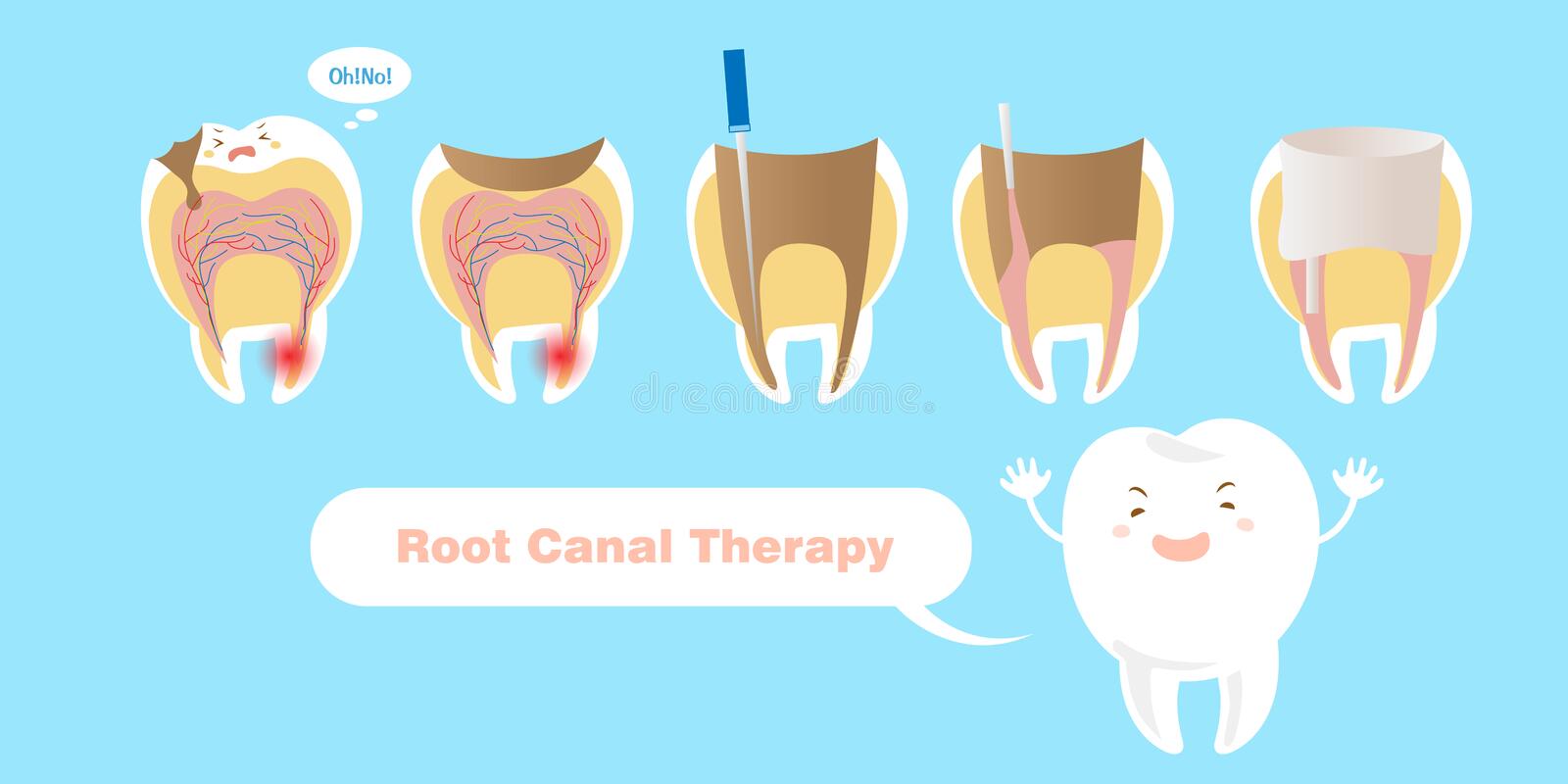 Root Canal Treatment