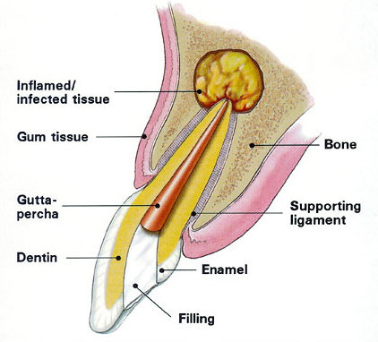 Bedah Endodontic